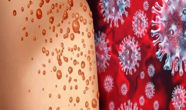 Mpox is scaring in Pakistan, now three new cases surfaced in Karachi; Government on high alert